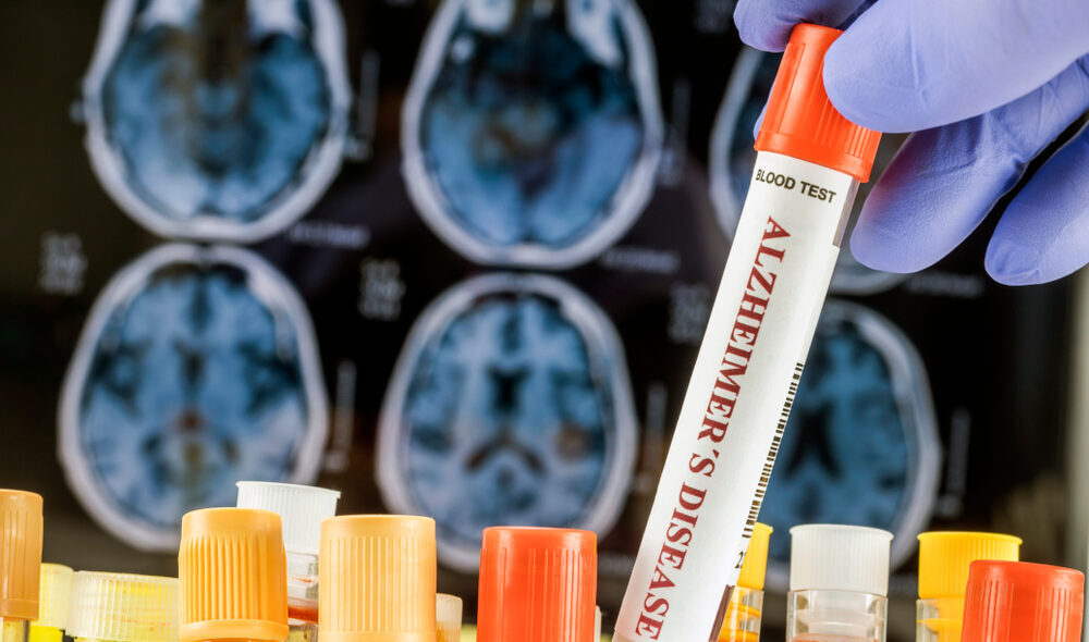 Organoidi cerebrali e ricerca sull'Alzheimer