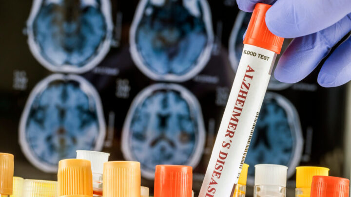 Organoidi cerebrali e ricerca sull'Alzheimer